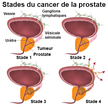 symptômes cancer de la prostate cause