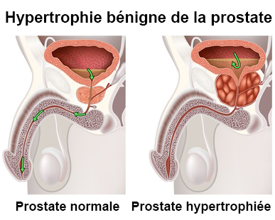 plante prostate hypertrophiée adenome prostate douleur dos