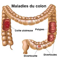 maladies du colon
