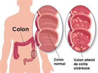 Colopathie : symptômes, traitement, définition - docteurclic.com