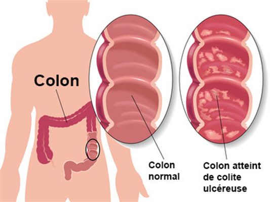 Recto-colite