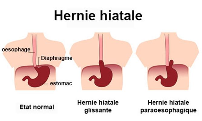 Hernie hiatale : symptômes, traitement, définition - docteurclic.com