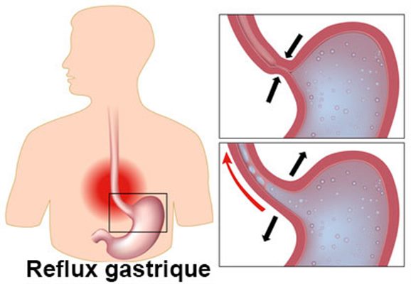 Maladies de l'oesophage