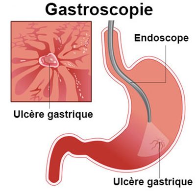 Gastroscopie