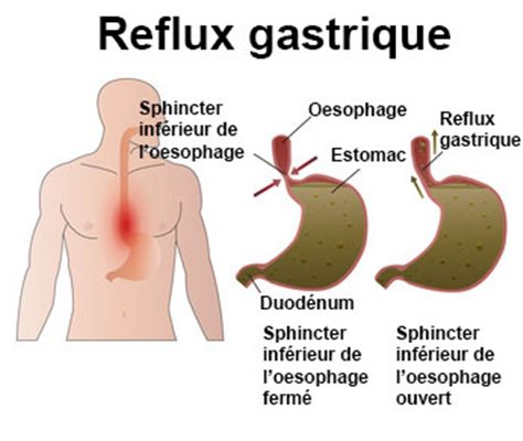 Reflux gastro-oesophagien de l'adulte