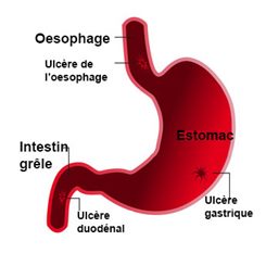 ulcères digestifs
