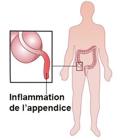 Appendicite : symptômes, traitement, définition - docteurclic.com