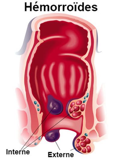 Hemorroide externe : ce que vous devez savoir ! 