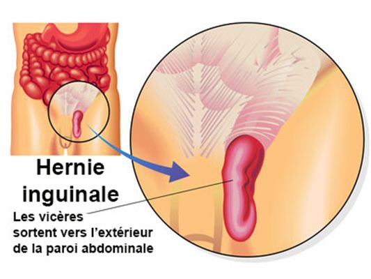 Hernie inguinale : symptômes, traitement, définition - docteurclic.com