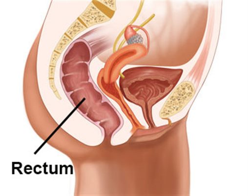 Maladies du rectum