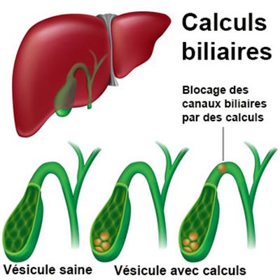 Calculs biliaires