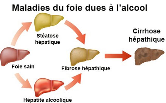 Cirrhose : symptômes, traitement, définition - docteurclic.com