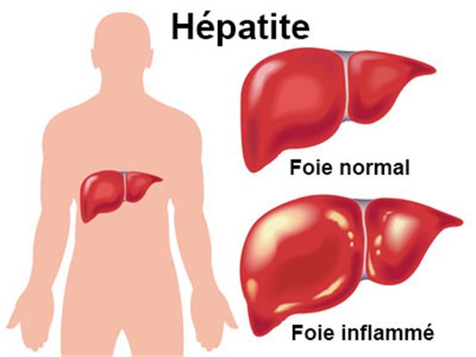 Hépatite : définition - docteurclic.com