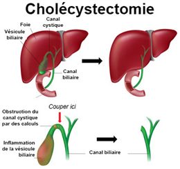 ablation de la vésicule biliaire