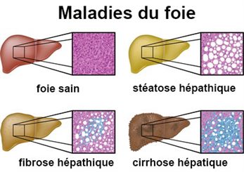 maladies du foie