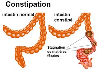 constipation