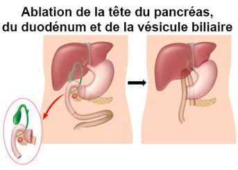 pancréatectomie