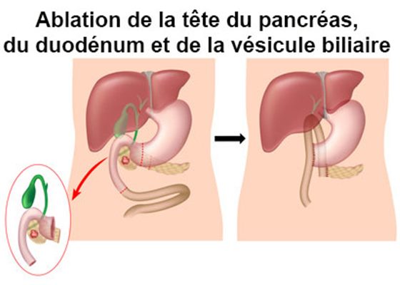 Pancréatectomie