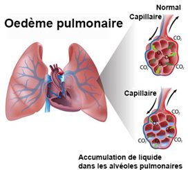 oedèmepulmonaire: OAP