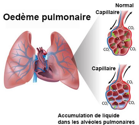 Oedème aigu du poumon: OAP