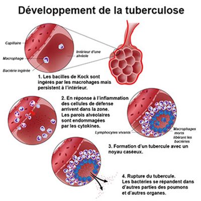 Tuberculose multi-résistante