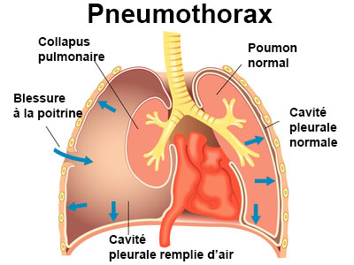 Pneumothorax : symptômes, traitement, définition - docteurclic.com