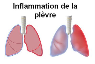inflammation de la plèvre