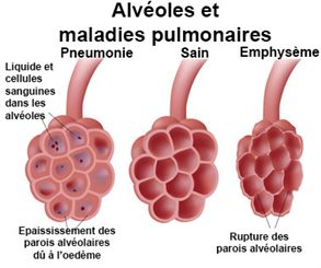 maladies pulmonaires