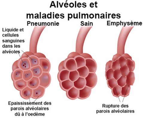 Maladies pulmonaires