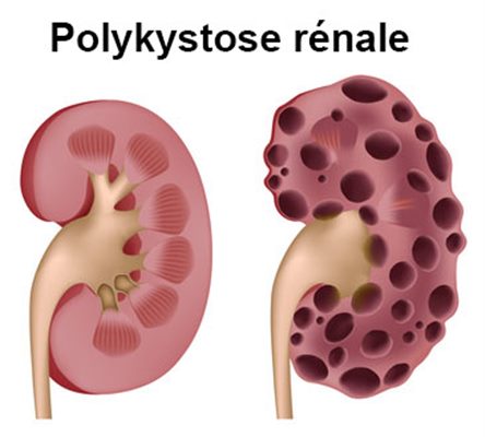 Polykystose rénale : symptômes, traitement, définition ...