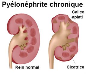 pyélonéphrite chronique