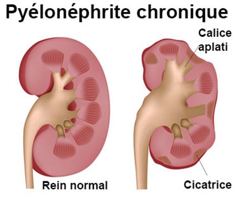 Py lon phrite Infection Des Reins Sympt mes Traitement D finition Py lon phrite Infection Des Reins Sympt mes Traitement D finition