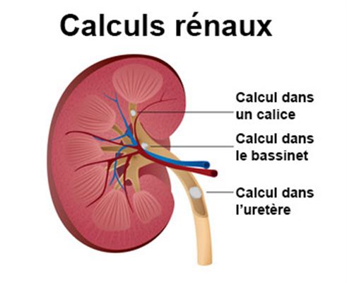 Lithiase rénale