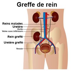 greffe de rein