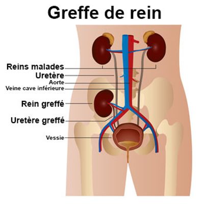 Néphrectomie : définition, technique - docteurclic.com