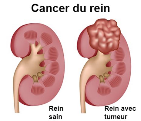 Néphroblastome : symptômes, traitement, définition - docteurclic.com