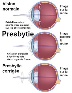 presbytie