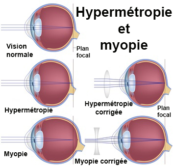Myope effets secondaires