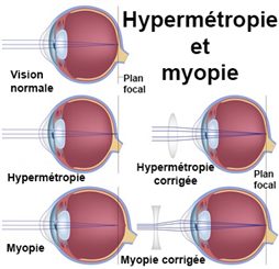 hypermétropie et myopie