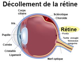 décollement de la rétine