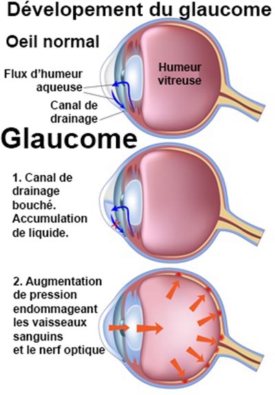 Que faire en cas de perte d'acuité visuelle (glaucome) ?