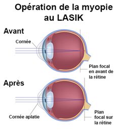 chirurgie au lasik