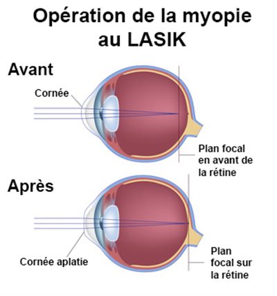 Lasik