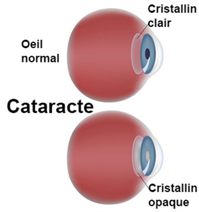 Cataracte