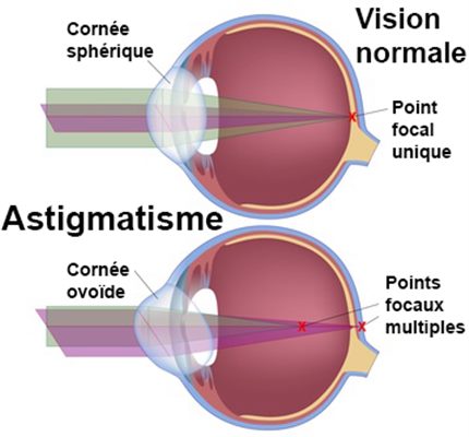 Astigmatisme