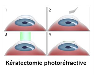 kératectomie