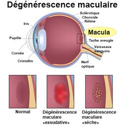 dégénérescence maculaire