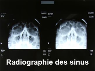 radiographie des sinus