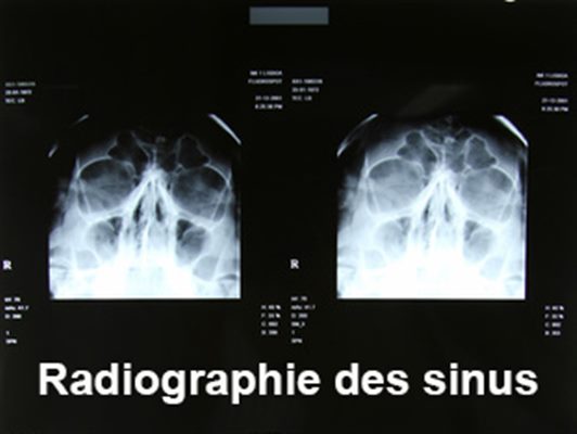 Radiographies des sinus