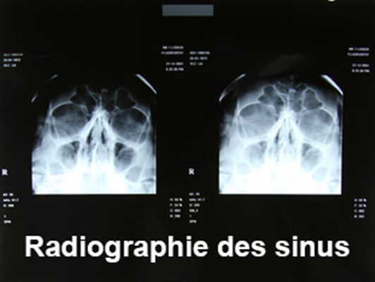 Radiographies des sinus examen - docteurclic.com